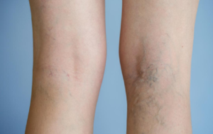 Varicose Veins