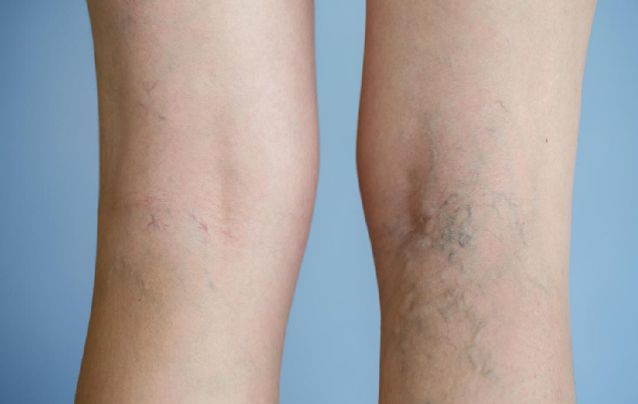 Varicose Veins