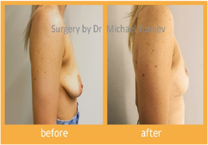 Everything You Should Know About Mastopexy