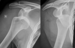What Are The Various Aspects Of Posterior Dislocation Of Shoulder?
