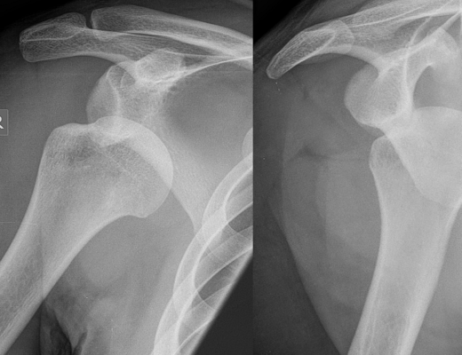 What Are The Various Aspects Of Posterior Dislocation Of Shoulder?