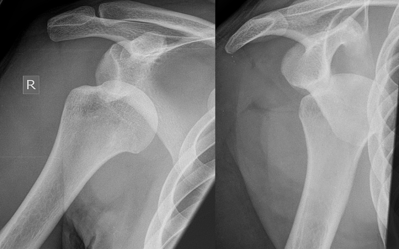What Are The Various Aspects Of Posterior Dislocation Of Shoulder?