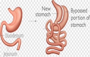 Revision Weight-Loss Surgery