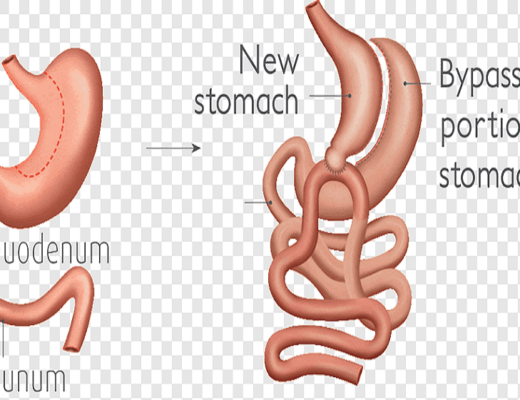 Revision Weight-Loss Surgery