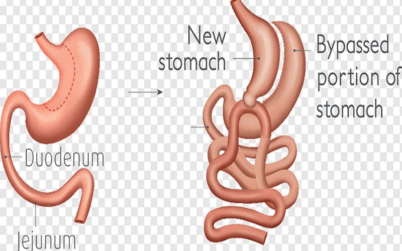 Revision Weight-Loss Surgery