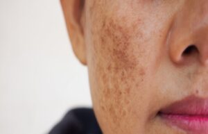 Products for Pigmentation Issues