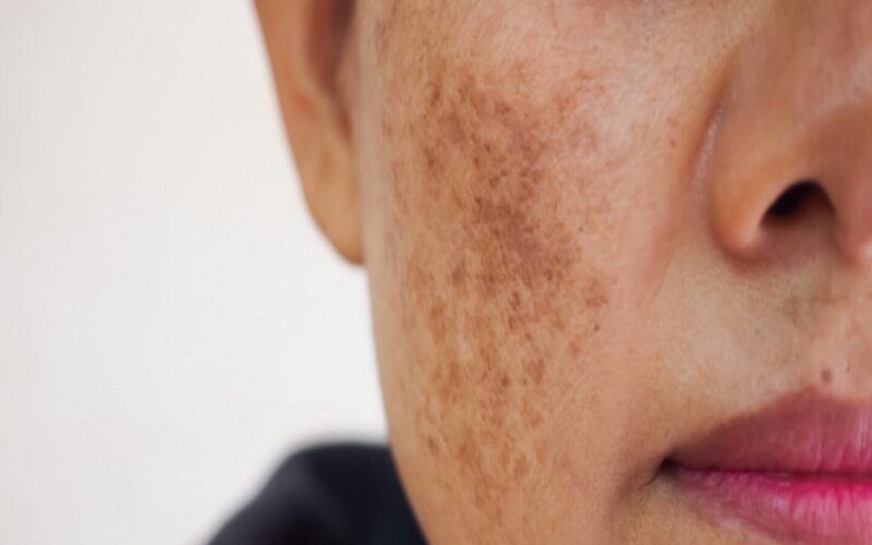 Products for Pigmentation Issues